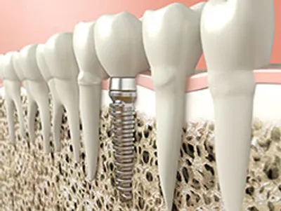 Dental Implants - Img1